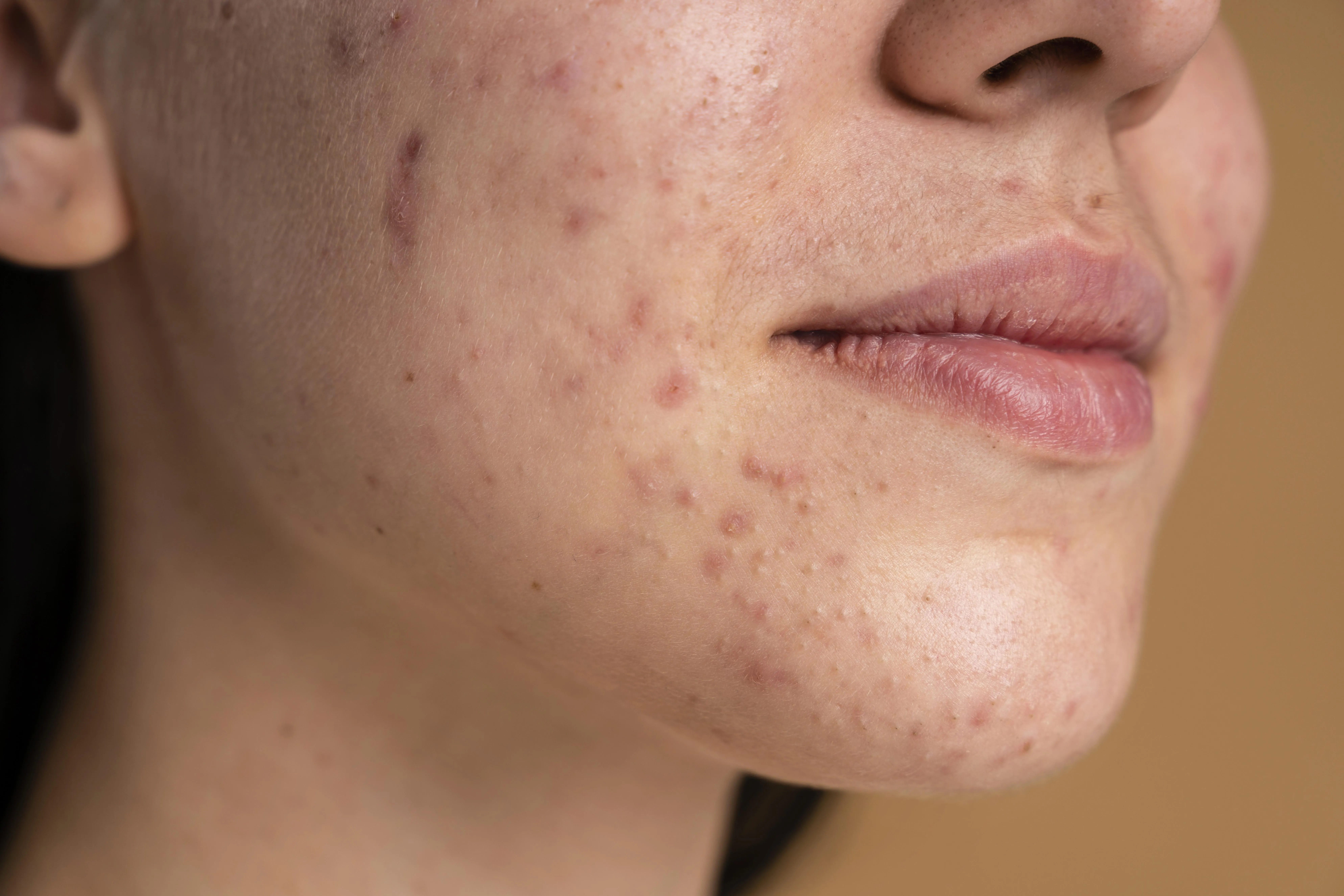 Imagem ilustrativa da notícia: Quais alimentos podem piorar a acne? Veja os mais prejudiciais