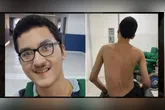 Com paralisia cerebral e escoliose grave, Samuel Cecim precisa de ajuda para cirurgia em SP.
