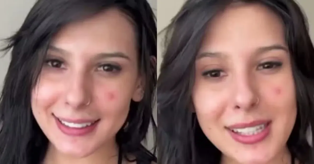 Imagem ilustrativa da notícia: Ana Castela mostra rosto com acne e desabafa: “bombinhas”