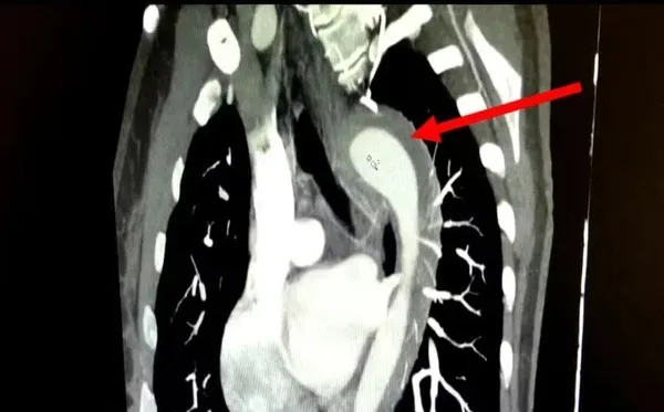 Imagem ilustrativa da notícia: Mulher rompe aorta durante relação sexual com o marido