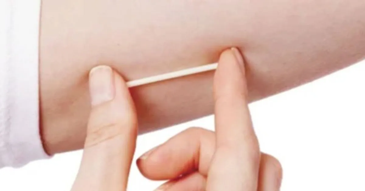 Imagem ilustrativa da notícia: SUS ofertará Implanon como método contraceptivo
