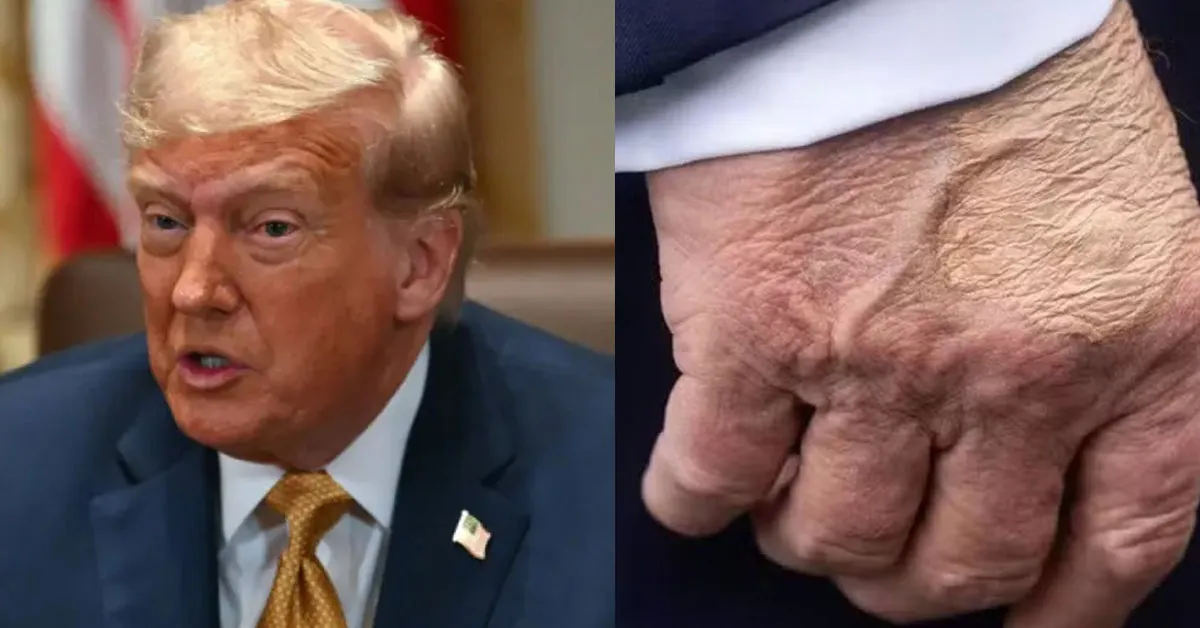 Imagem ilustrativa da notícia: Insuficiência venosa crônica: entenda a doença que afeta Donald Trump