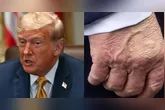 Insuficiência venosa crônica que afeta Trump: conheça as causas, sintomas e cuidados.
