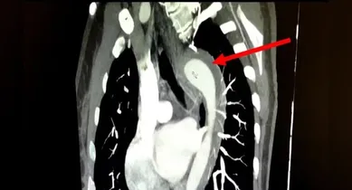 Imagem ilustrativa da notícia: Mulher rompe aorta durante relação sexual com o marido