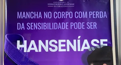 Imagem ilustrativa da notícia: Roda Hans oferece diagnóstico precoce de hanseníase em Marabá