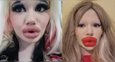 Imagem ilustrativa da notícia: Mulher gasta mais de R$ 140 mil para ter “maiores lábios do mundo”