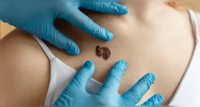 Imagem ilustrativa da notícia: IA revoluciona diagnóstico de câncer de pele com com 95% de precisão