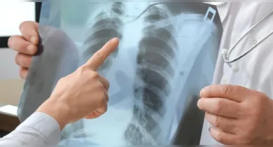 Imagem ilustrativa da notícia: Tosse que não passa pode ser sinal de tuberculose: quando procurar ajuda?