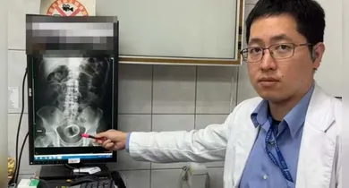 Imagem ilustrativa da notícia: Homem com prisão de ventre descobre xícara no ânus em hospital