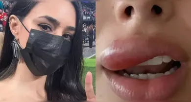 Imagem ilustrativa da notícia: Bruna Biancardi sofre com inchaço facial após espremer espinha