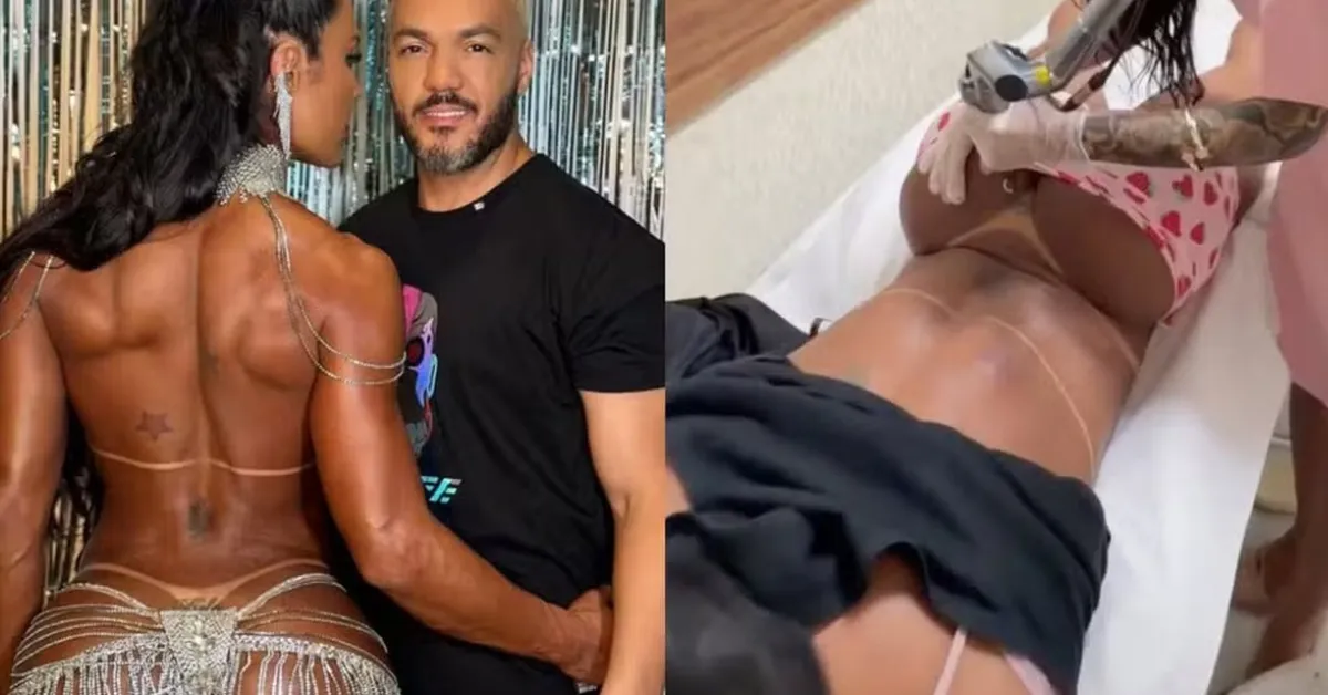 Imagem ilustrativa da notícia: Gracyanne Barbosa começar a remover tatuagem em homenagem a Belo