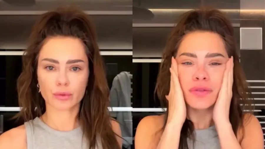 Imagem ilustrativa da notícia: Dermatologista explica mudanças no rosto de Carolina Dieckmann