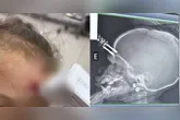 Exame de raio-X mostra o objeto cravado na testa da criança