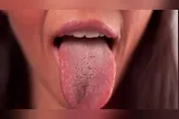Imagem ilustrativa da notícia Língua esbranquiçada? Veja os problemas de saúde que isso pode ser