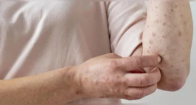 Imagem ilustrativa da notícia: Brasil chega a 55 casos de Mpox e identifica nova variante em 2026