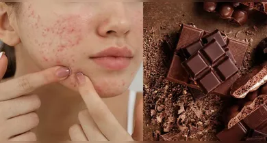 Imagem ilustrativa da notícia: Chocolate provova acne? Saiba a verdade para aproveitar a Páscoa sem culpa