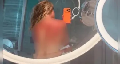 Imagem ilustrativa da notícia: Tenista exibe queimaduras após jogo sob calor extremo na Austrália