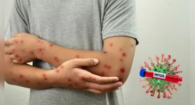 Imagem ilustrativa da notícia: Mpox avança no Brasil: país já registra 88 casos em 2026