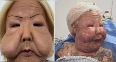 Imagem ilustrativa da notícia: Juju do Pix faz nova cirurgia para retirar óleo mineral do rosto
