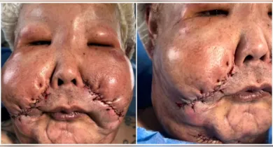 Imagem ilustrativa da notícia: Médico mostra rosto de Juju do Pix após retirar óleo mineral