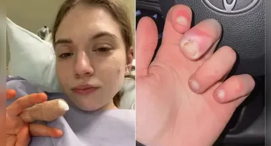 Imagem ilustrativa da notícia: Hábito de roer unhas quase leva jovem à amputação de dedo