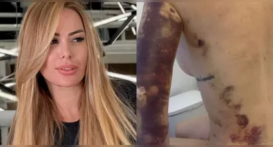 Imagem ilustrativa da notícia: Influencer revela dismorfia corporal após R$ 500 mil em procedimentos