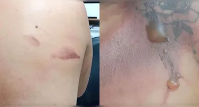 Imagem ilustrativa da notícia: Homem é preso por jogar água quente em companheira no Pará