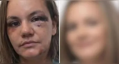 Imagem ilustrativa da notícia: Mulher agredida com 61 socos pelo ex mostra reconstrução facial