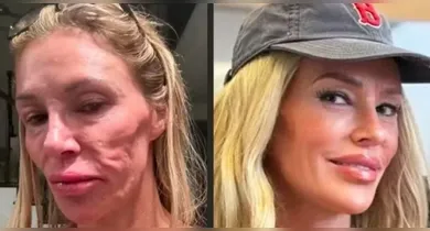 Imagem ilustrativa da notícia: Criadora de conteúdo gasta R$ 1 milhão após "derretimento facial"