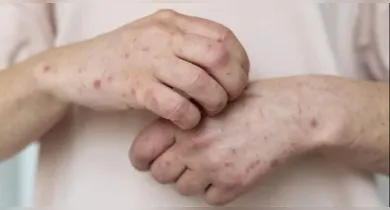 Imagem ilustrativa da notícia: Brasil registra alta de Mpox e acende alerta em estados