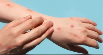 Imagem ilustrativa da notícia: Mpox: como está o surto no Brasil e estados com mais casos