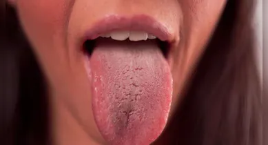 Imagem ilustrativa da notícia: Língua esbranquiçada? Veja os problemas de saúde que isso pode ser