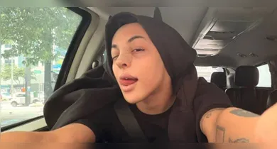 Imagem ilustrativa da notícia: Mistério, curativos e revelação: veja o novo rosto de Pabllo Vittar