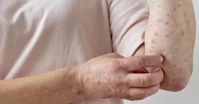 A mpox é causada pelo vírus MPXV, do gênero Orthopoxviru