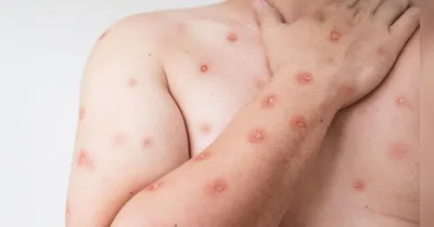 Caso de Mpox é confirmado em Porto Alegre. Veja os sintomas da doença e como se prevenir!