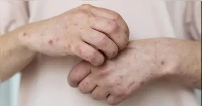 A doença viral e transmissível voltou a ser monitorada de perto pelo governo, embora esteja longe do surto de 2022.