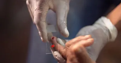 O público infantil concentra cerca de 50% dos casos da doença no país.