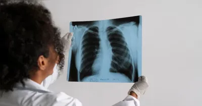 Imagem ilustrativa da notícia Reflexões sobre o 24 de março, Dia Mundial de Combate à Tuberculose