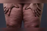 Campanha do Junho Roxo chama atenção para sintomas, diagnóstico e tratamento do lipedema, doença que afeta principalmente mulheres.