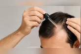 Minoxidil age nas células ao redor da raiz, melhora a circulação na região e prolonga a fase de crescimento do cabelo.