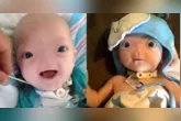 Menino que nasceu sem nariz virou símbolo de inclusão após escolha emocionante da família.