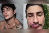 Influenciador foi internado após espreme uma espinha na região do "triângulo da morte".