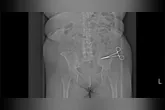 "É um milagre ela estar viva", diz família após mulher descobrir tesoura cirúrgica esquecida no abdômen sete meses depois de abdominoplastia na Itália.