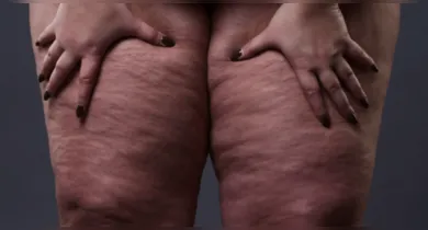 Imagem ilustrativa da notícia: Lipedema: conheça os sintomas e tratamento da doença que afeta as mulheres