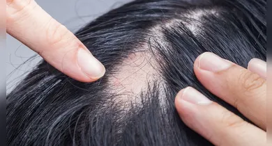 Imagem ilustrativa da notícia: Alopecia areata: o que causa e como tratar as falhas no cabelo