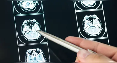 Imagem ilustrativa da notícia: Risco de AVC: 7 coisas que nunca deve fazer, segundo médicos