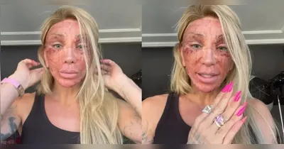 Maya Massafera surpreendeu os seguidores após surgir com o rosto completamente avermelhado depois do processo de recuperação do Laser de CO2.