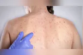 O sarampo é doença viral infecciosa aguda altamente contagiosa e potencialmente grave, podendo deixar sequelas ou levar à morte.