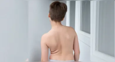 Imagem ilustrativa da notícia: Escoliose em adolescentes: como identificar e quando procurar um especialista