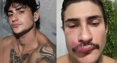 Imagem ilustrativa da notícia: Influenciador é internado após espremer espinha na face